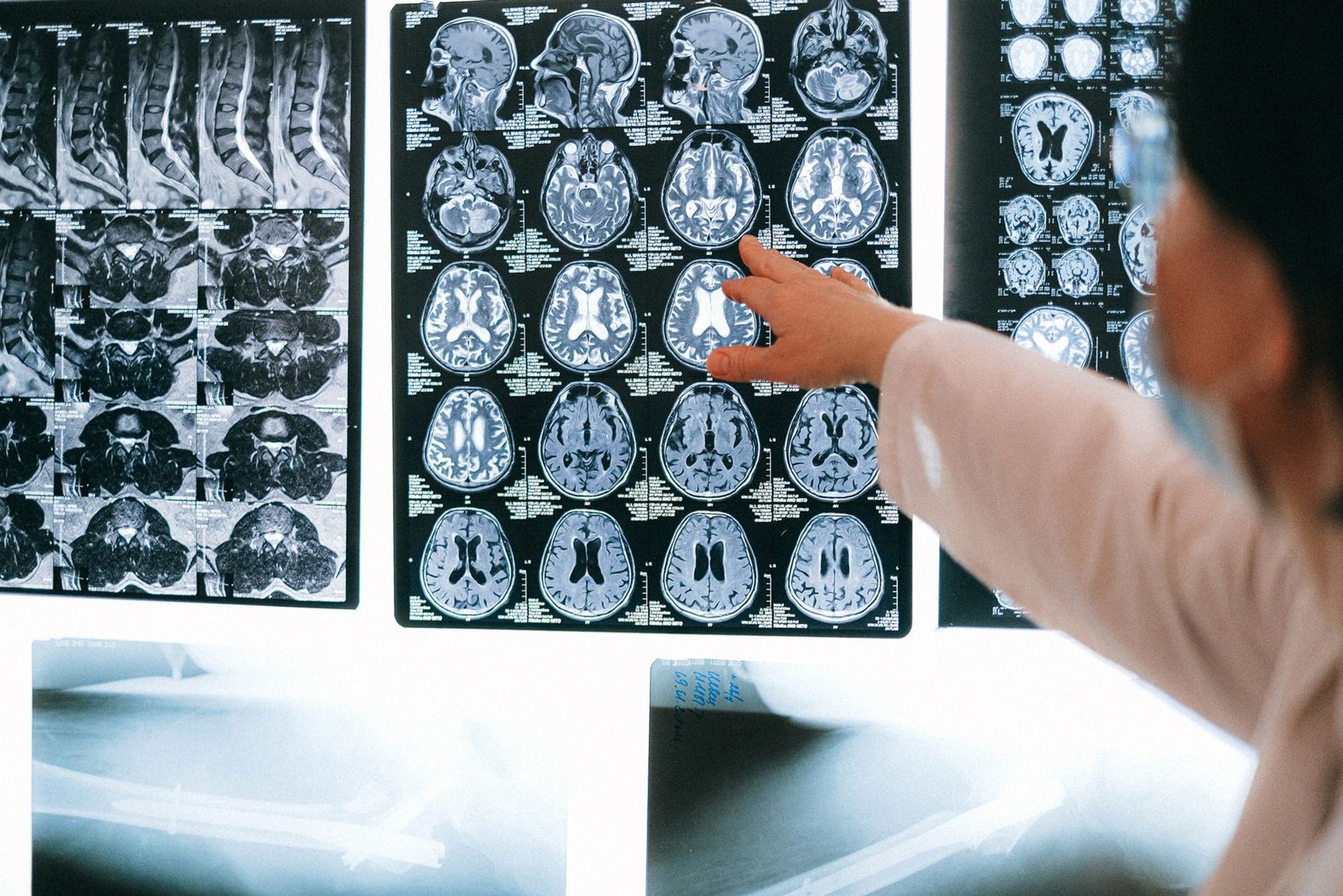 Clinician reviewing brain MRI slices on a lightbox